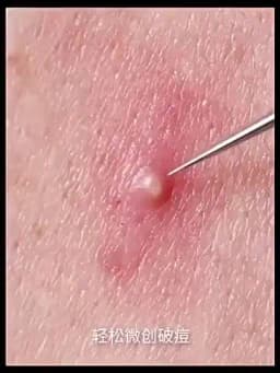New German Ultra-fine Cell Pimples Blackhead Whitehead Clip Beauty Salon Special Remove Acne Fat Particles Needle Tool