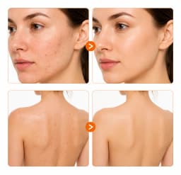5PCS Persimmon Deodorizing Soap Bars with Foaming Bags, Deep Cleansing Body Soap with Shea Butter, Fresh Skin Care for Shower &