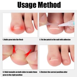 10pc/box Ingrown Toenail Correction Tool Straightening Clip Brace Ingrown Toe Nail Treatment Elastic Patch Sticker Pedicure Tool