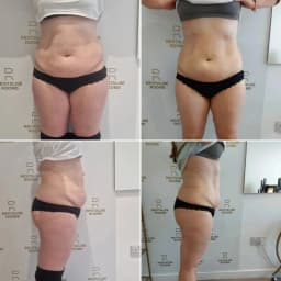 EMS Body Sculpting Machine RF Myoslim NEO Sculpt Slimming Fat Muscle Stimulation Massager Electromagnetic Weight Loss