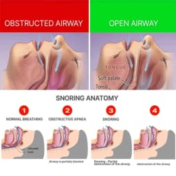 Eelhoe Anti-Snoring Braces Teeth Grinding Breathing Mouthguard Dental Tray Protector Stop Snoring Device Improve Sleep