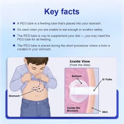 Califed Silicone Gastrostomy Tube Multi Functional Connector X-Ray Medical PEG Tube With Balloon Gastrostomy Surgical Equipment