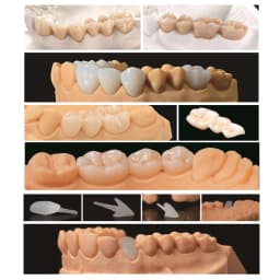 OEM Custom Dentures Fixed Restorations CAD/CAM Multilayered Zirconia IPS e.Max Veneer Post PFM Co-Cr Alloy FMC Bridge