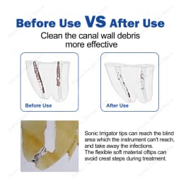 30pcs Dental Sonic Irrigator Tips Endoactivator Tips Root Canal Treatment Activator Endodontic Irrigation Dentistry Endo Dental