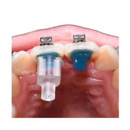 Dental Materials Mini Orthodontic Accessories Injection Mould Bracket Lingual Button