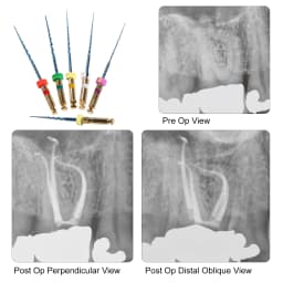 6pcs/1Pack Dental Endo Files Endodontic NiTi Rotary Root Canal Reciprocating File 21/25/31mm Machine Use for Shaping & Cleaning