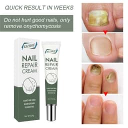 25g Nail Care Cream Anti-fungals Nail Therapy Serum Foot Nail Fungi Removal Gel Anti Infected Paronychia Onychomycosis Product