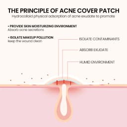 240 pieces of multi-color star acne patches, facial acne patches, concealer acne patches, and pimples patches, ultra-thin