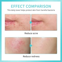 Hypochlorous Acid Spray Toner for Face Helps Reduce Redness Breakouts Soothing pH Balancing Toner Skincare