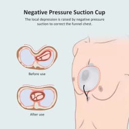 Pectus Excavatum Vacuum Bell,Pectus Excavatum Orthosis Brace,Sternal Depression Support Sunken Chest-Physical Chest Correction