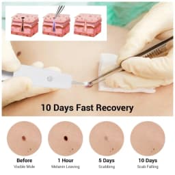 Skin Tag Remover Electric Laser Plasma Pen Black Dot Papilloma Wart Remover Dark Spot Mole Warts Eliminator Lcd Plasma Pen