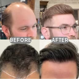 Men's Forehead Hairline Wig High Density Human Hair Skin PU Men's Frontal Hairpiece V Ring Frontal Hair Top