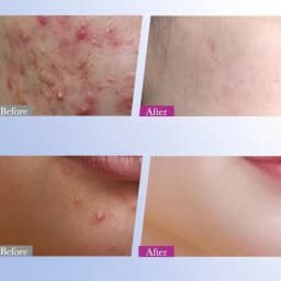 8/16Pcs Colorful Star Acne Patch Improve Women Skin Hydrocolloid Acne Tool Acne Cover Pimple Patch Portable Skin Care Tools