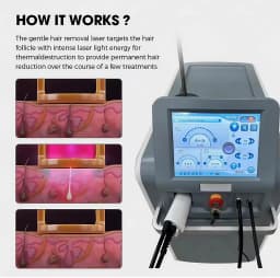 2026 SLyriclaser 1064/532nm long pulse width High quality 1064nm painless hair removal Clinic 755NM alexandrite machine