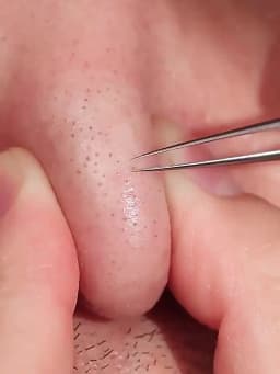 German Ultra-fine No. 5 Cell Pimples Blackhead Clip Tweezers Beauty Salon Special Scraping & Closing Artifact Acne Needle Tool