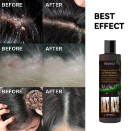 EELHOE Hair Cleaning Shampoo Anti Dandruff Remove Mites Relieve Itching Oil Control Scalp Cleaning Refreshing Hair Shampoo
