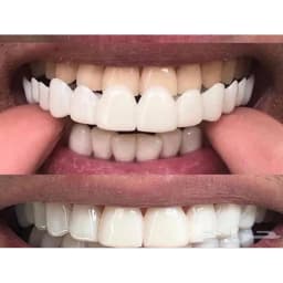 Soft Silicone Gel Dental Oral Upper Lower Fake False Teeth Cover Smile Veneers Dentures Braces Dental Equipment Whitening Molds
