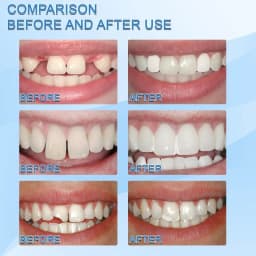 Temporary Tooth Repair Beads Missing Broken Teeth Dental Tooth Filling Material Food Grade False Teeth Solid Glue Denture