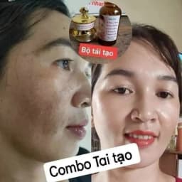 Whitening Set Vietnamese Imported Comboserumfacekemtaitao Reduce Facial Puffiness Eliminate Acne Reduce Large Pores