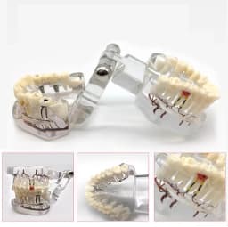 AG Teeth Neural Repair Dental Implant Pathological Model Dentist Students Communication Learning Research Oral Disease Teaching